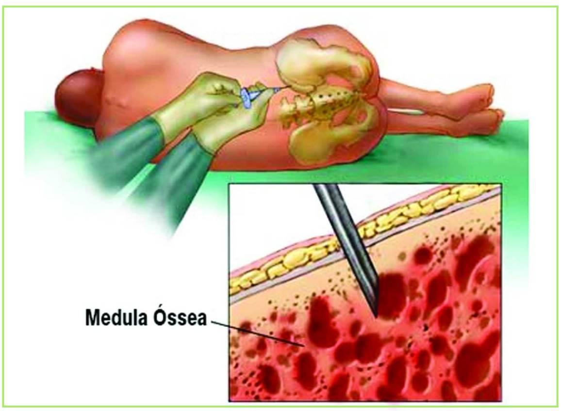 Medula Óssea na Medicina Regenerativa