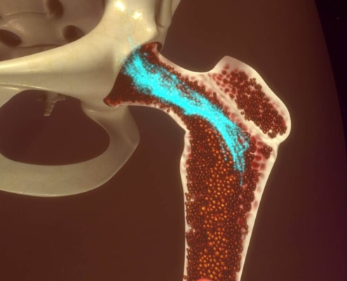 Medula Óssea: O Poder Regenerativo no Tratamento de Problemas Articulares