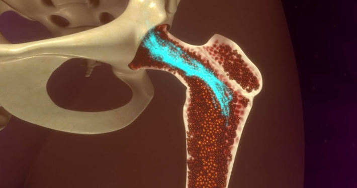 Medula Óssea: O Poder Regenerativo no Tratamento de Problemas Articulares